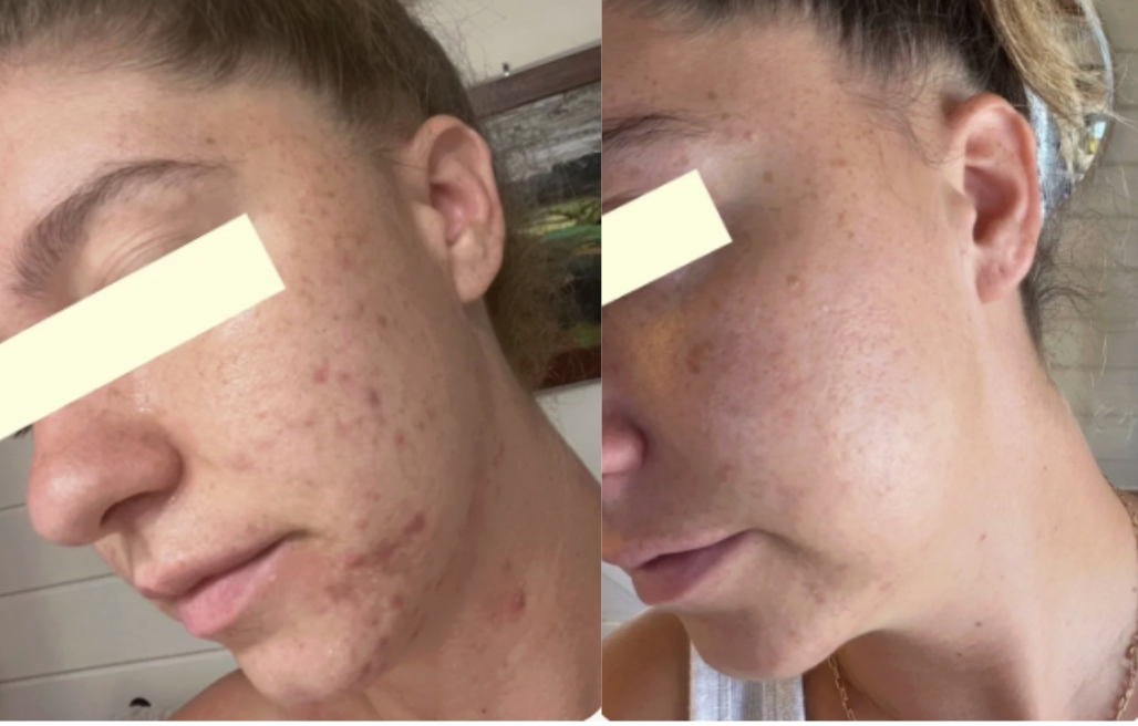 Root cause acne specialist and naturopathic doctor offering virtual 1:1 sessions and functional lab testing to uncover hormonal, gut, and lifestyle imbalances driving acne. Clear your skin from the inside out with personalized, holistic care.