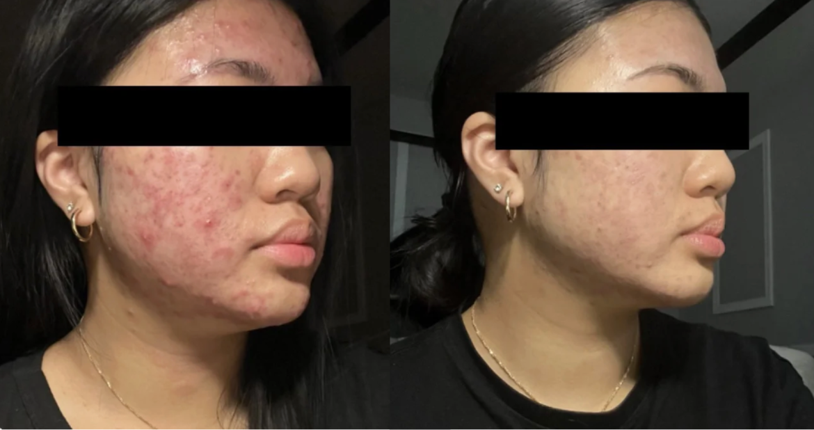 Root cause acne specialist and naturopathic doctor offering virtual 1:1 sessions and functional lab testing to uncover hormonal, gut, and lifestyle imbalances driving acne. Clear your skin from the inside out with personalized, holistic care.