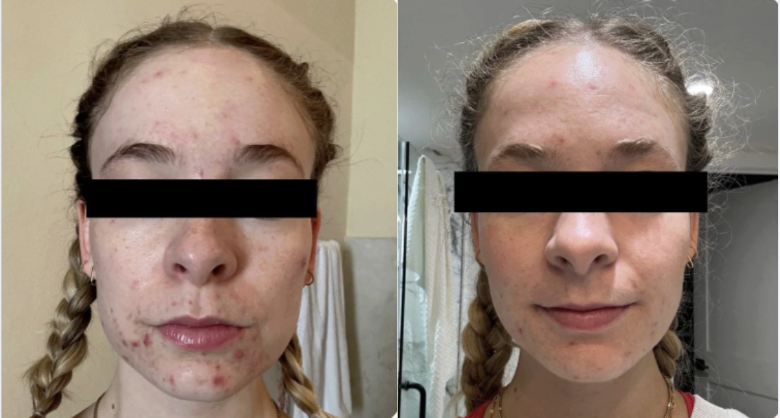 Root cause acne specialist and naturopathic doctor offering virtual 1:1 sessions and functional lab testing to uncover hormonal, gut, and lifestyle imbalances driving acne. Clear your skin from the inside out with personalized, holistic care.