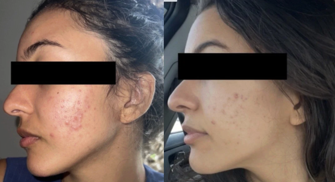 Root cause acne specialist and naturopathic doctor offering virtual 1:1 sessions and functional lab testing to uncover hormonal, gut, and lifestyle imbalances driving acne. Clear your skin from the inside out with personalized, holistic care.