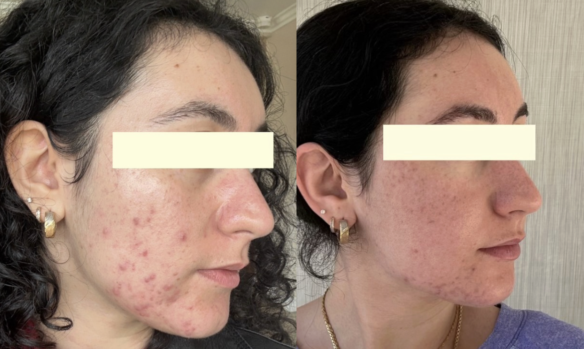 Root cause acne specialist and naturopathic doctor offering virtual 1:1 sessions and functional lab testing to uncover hormonal, gut, and lifestyle imbalances driving acne. Clear your skin from the inside out with personalized, holistic care.