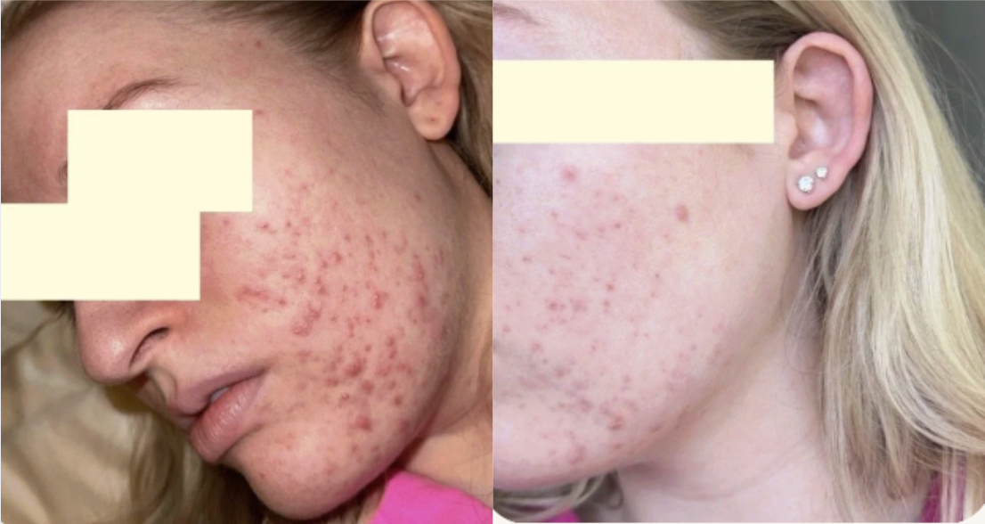 Root cause acne specialist and naturopathic doctor offering virtual 1:1 sessions and functional lab testing to uncover hormonal, gut, and lifestyle imbalances driving acne. Clear your skin from the inside out with personalized, holistic care.