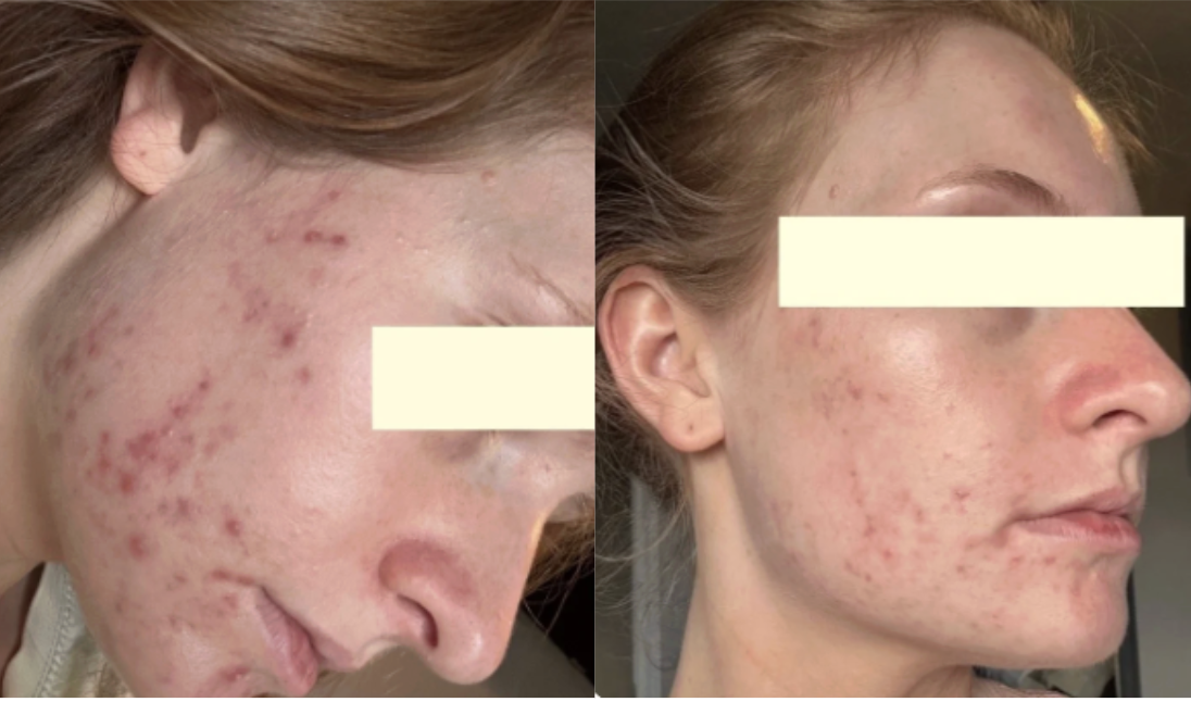Root cause acne specialist and naturopathic doctor offering virtual 1:1 sessions and functional lab testing to uncover hormonal, gut, and lifestyle imbalances driving acne. Clear your skin from the inside out with personalized, holistic care.