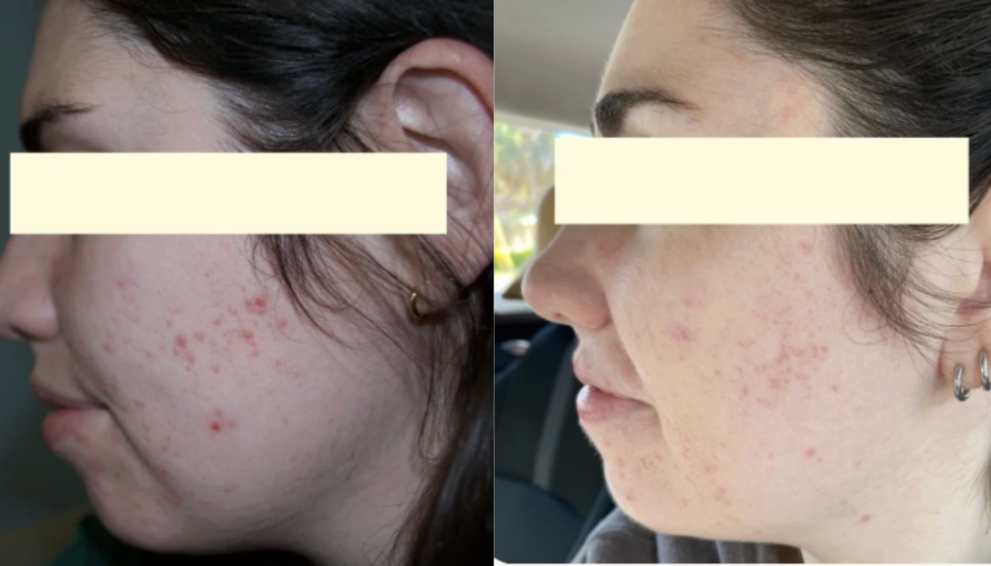 Root cause acne specialist and naturopathic doctor offering virtual 1:1 sessions and functional lab testing to uncover hormonal, gut, and lifestyle imbalances driving acne. Clear your skin from the inside out with personalized, holistic care.