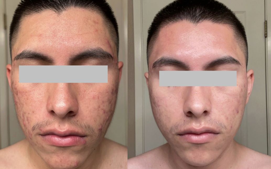 Root cause acne specialist and naturopathic doctor offering virtual 1:1 sessions and functional lab testing to uncover hormonal, gut, and lifestyle imbalances driving acne. Clear your skin from the inside out with personalized, holistic care. Holisti