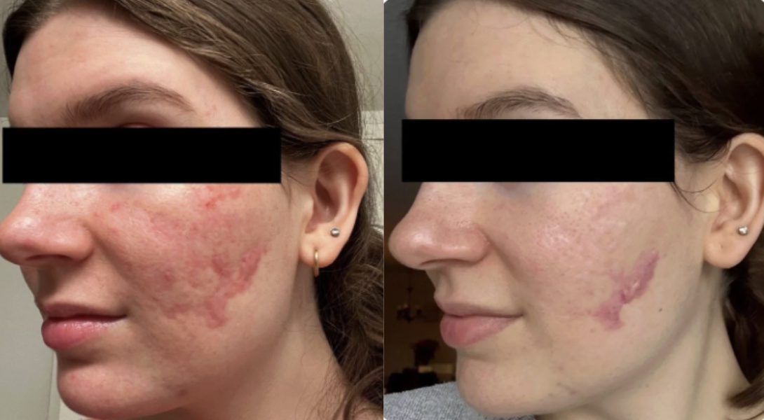 Root cause acne specialist and naturopathic doctor offering virtual 1:1 sessions and functional lab testing to uncover hormonal, gut, and lifestyle imbalances driving acne. Clear your skin from the inside out with personalized, holistic care.