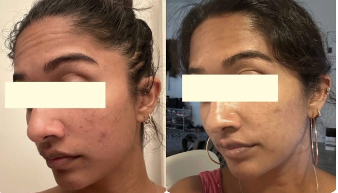 Root cause acne specialist and naturopathic doctor offering virtual 1:1 sessions and functional lab testing to uncover hormonal, gut, and lifestyle imbalances driving acne. Clear your skin from the inside out with personalized, holistic care.