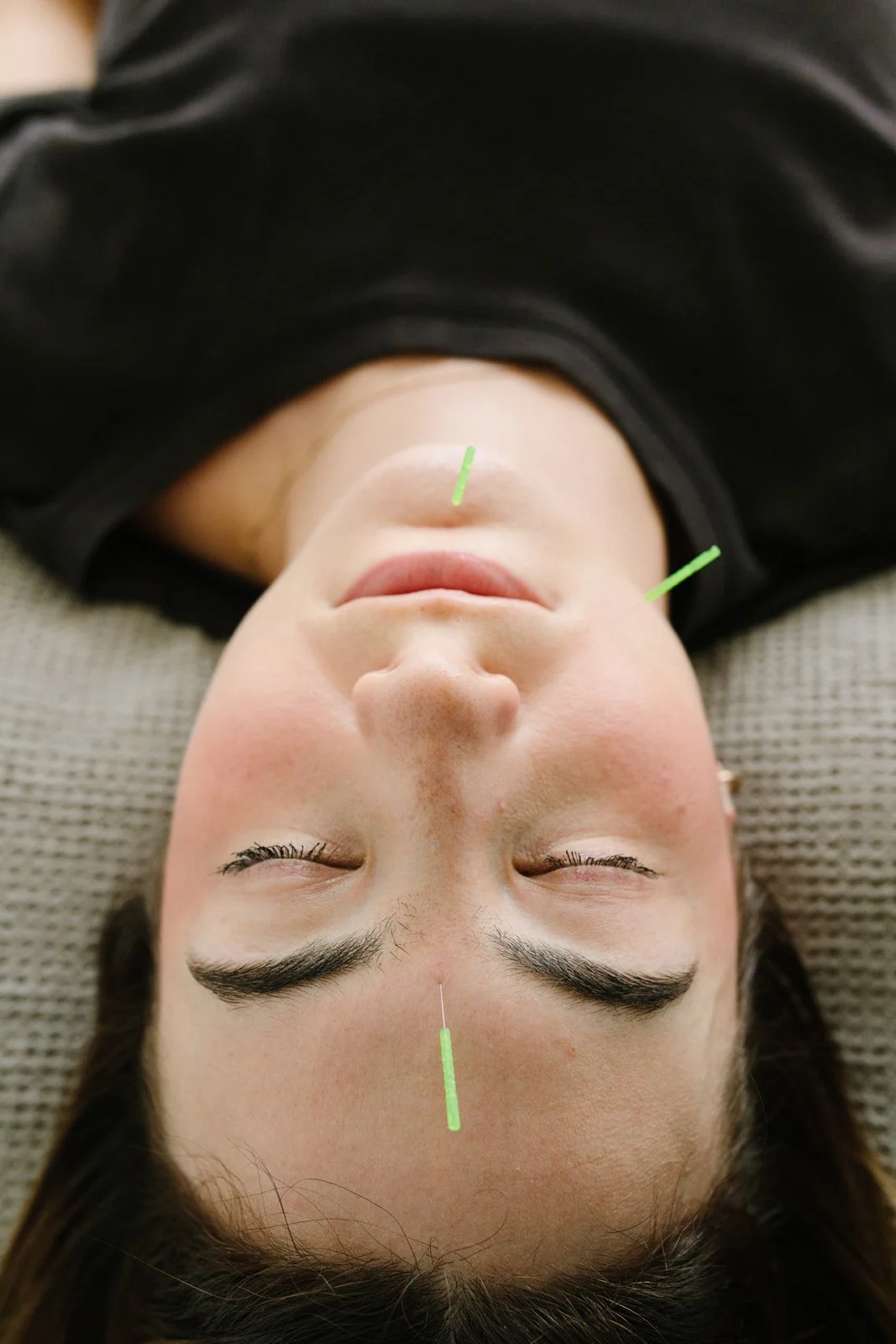 A woman lying down with her eyes closed, receiving acupuncture treatment, with several thin needles inserted into her face and forehead.