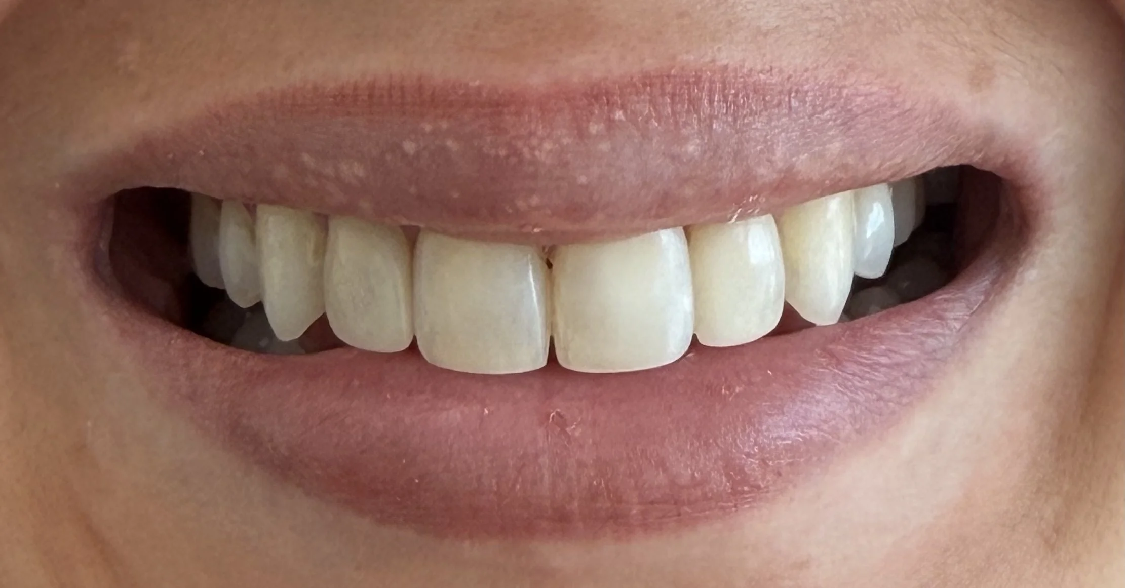 After photo of composite bonding showing previously present gaps closed and beautiful smile
