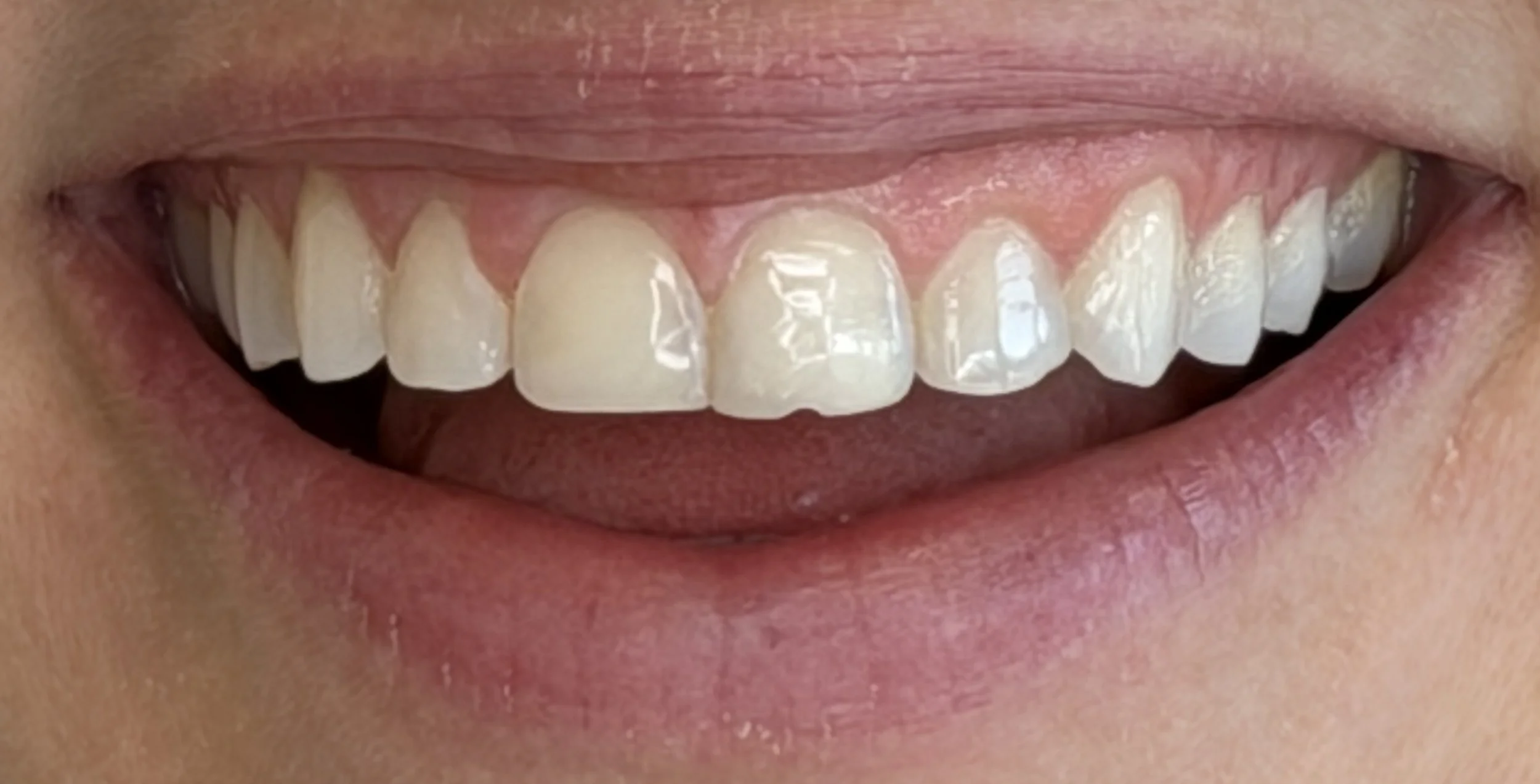 Before photo of composite bonding with chipped/uneven teeth