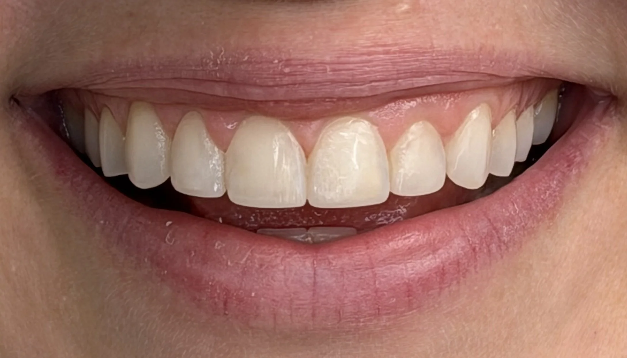 After photo of composite bonding showing beautifully re-shaped teeth
