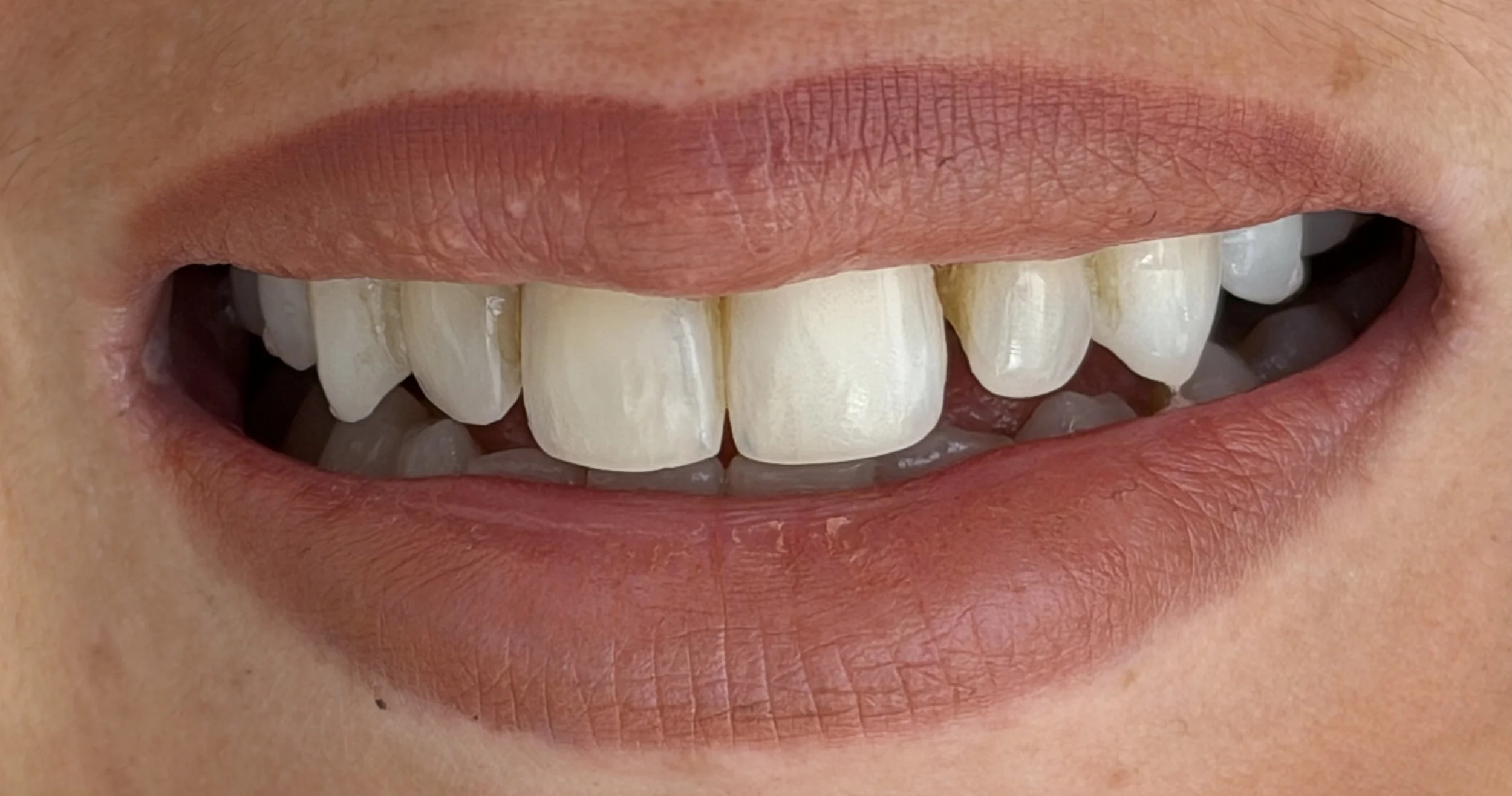 Before photo for composite bonding showing gaps in teeth