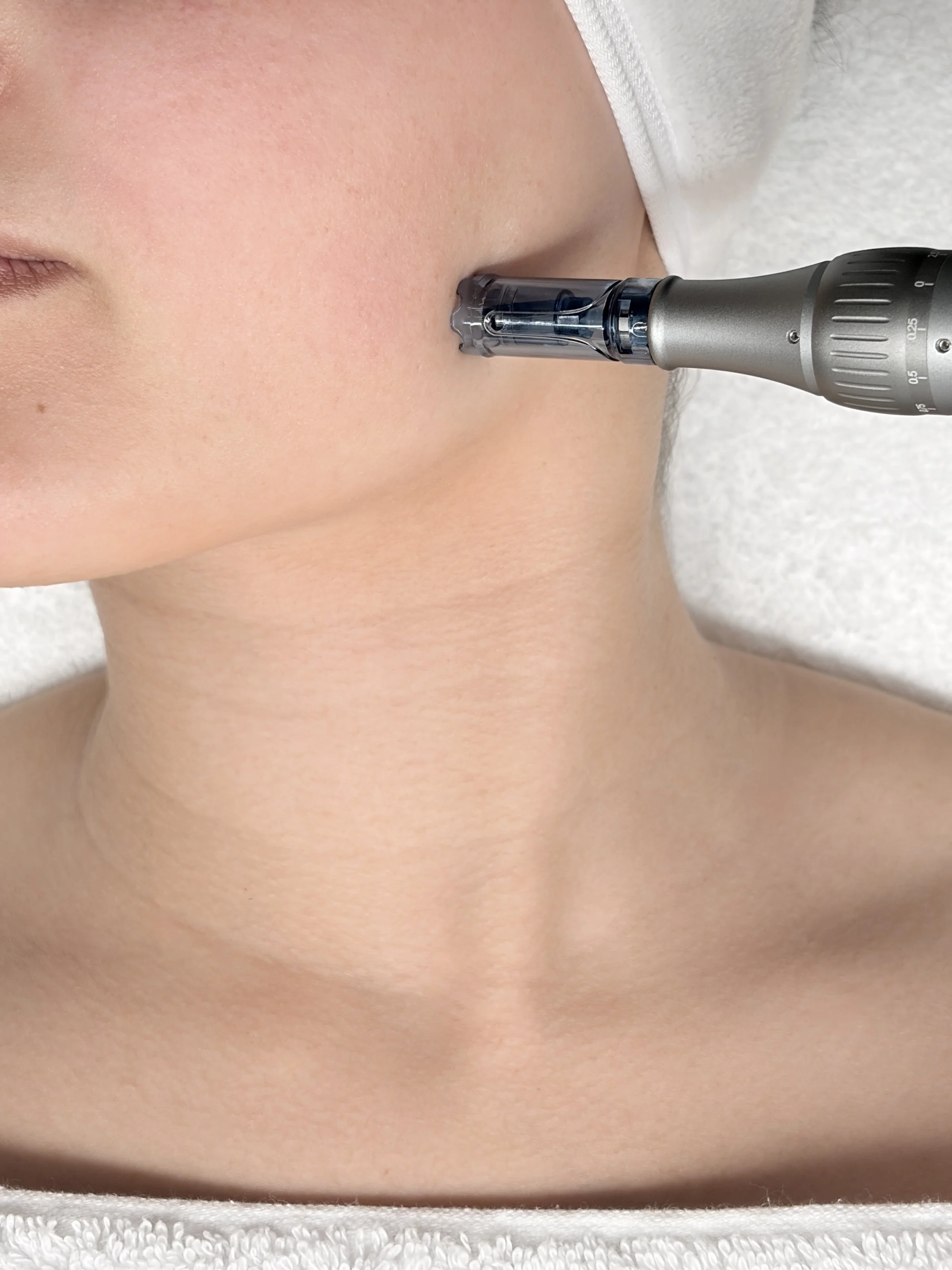 Microneedling stimuleert de natuurlijke collageenaanmaak van de huid. De huid gestimuleerd om zichzelf te herstellen. Dit helpt bij littekens, fijne lijntjes en grove poriën, pigmentvlekken. De huid wordt steviger en egaler.