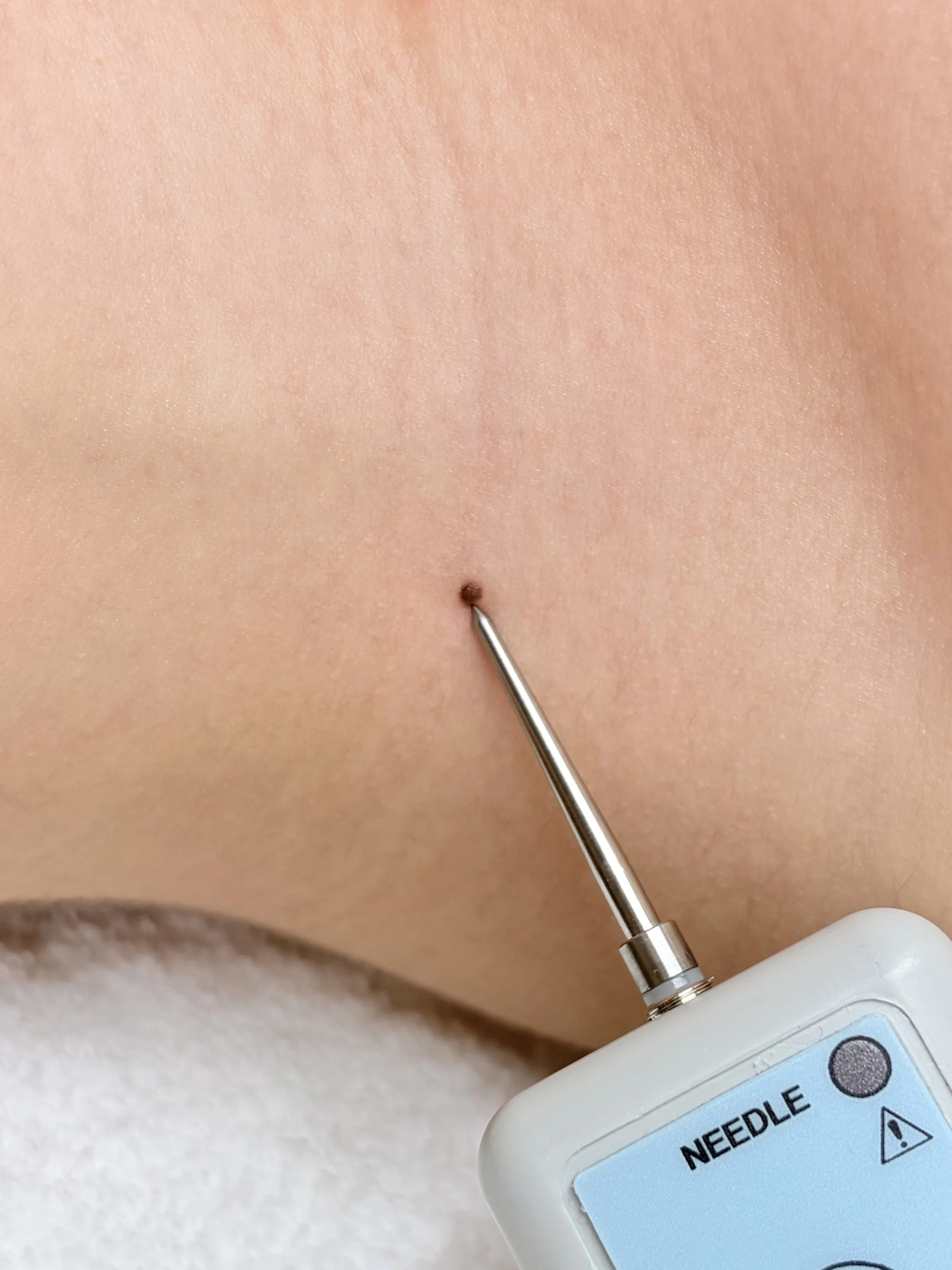 Coagulatie therapie verwijderd huidoneffenheden zoals steelwratjes, ouderdomswratjes, fibromen.
