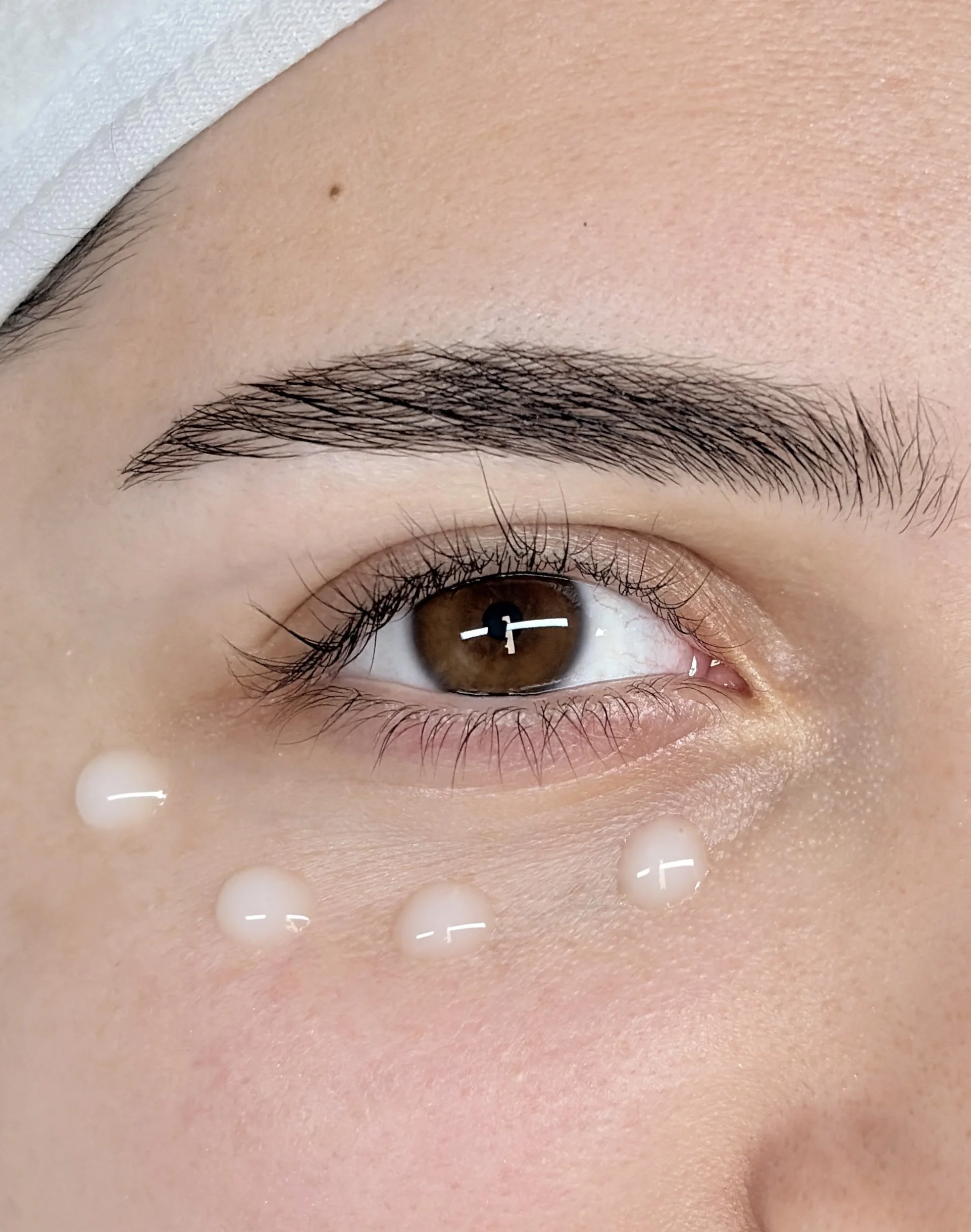 Microneedling of chemische peeling rondom de ogen vermindert donkere kringen, kraaienpootjes, rimpels, fijne lijntjes, wallen en vochtwallen. De behandeling verstevigt de dunne huid rond de ogen en zorgt voor een frissere uitstraling.