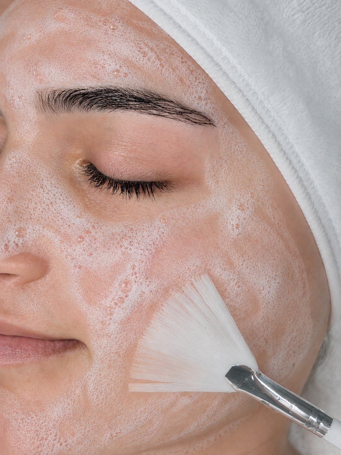 Acne behandeling is gericht op het verminderen van acne, talgproductie, mee eters verstopte poriën, acne littekens en roodheid. Acne therapie is geschikt voor pubers, tieners en volwassenen.