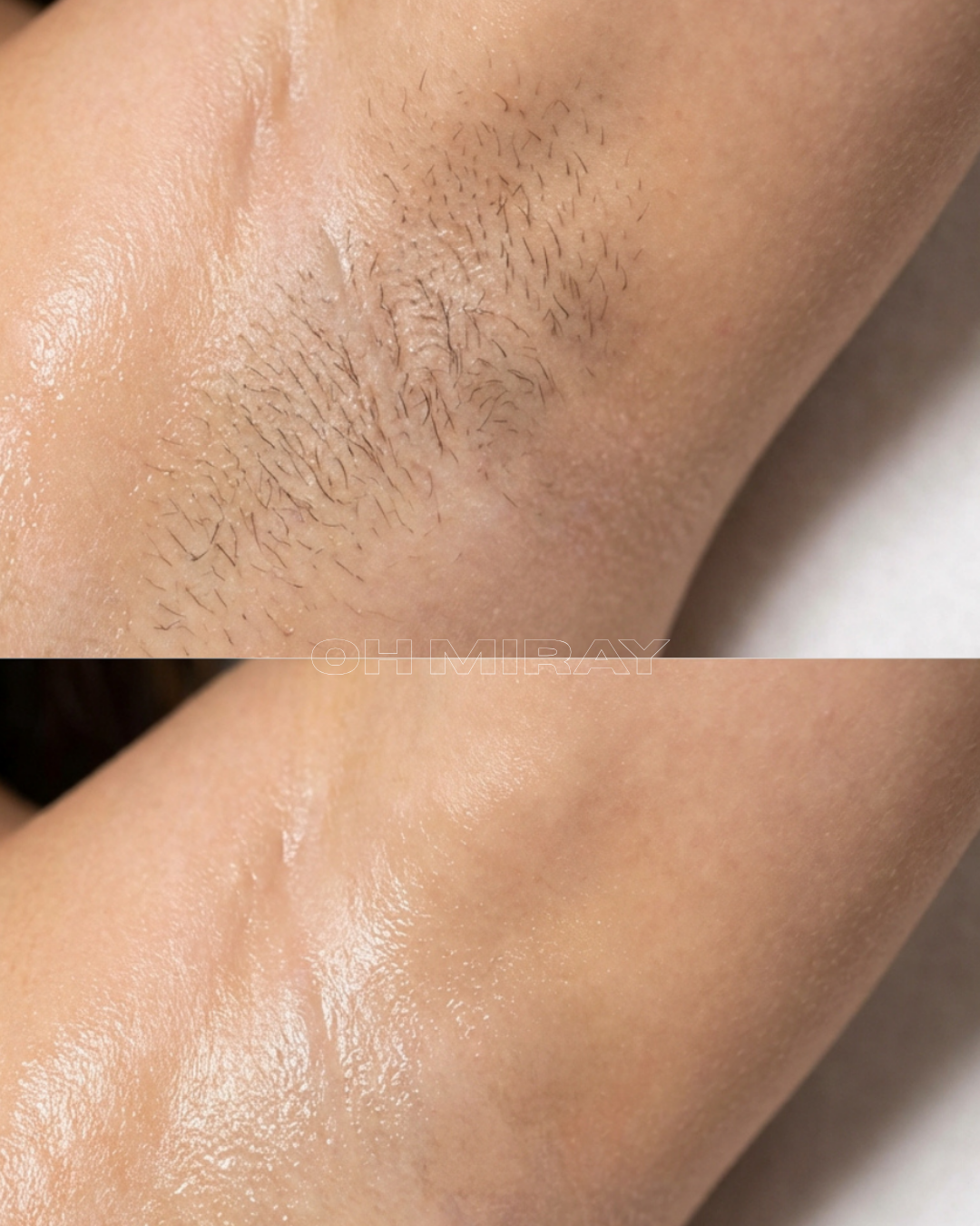 Close-up image of underarm skin. The top part shows hair and slightly darker skin, while the bottom part shows smooth, hairless, and slightly shiny skin.