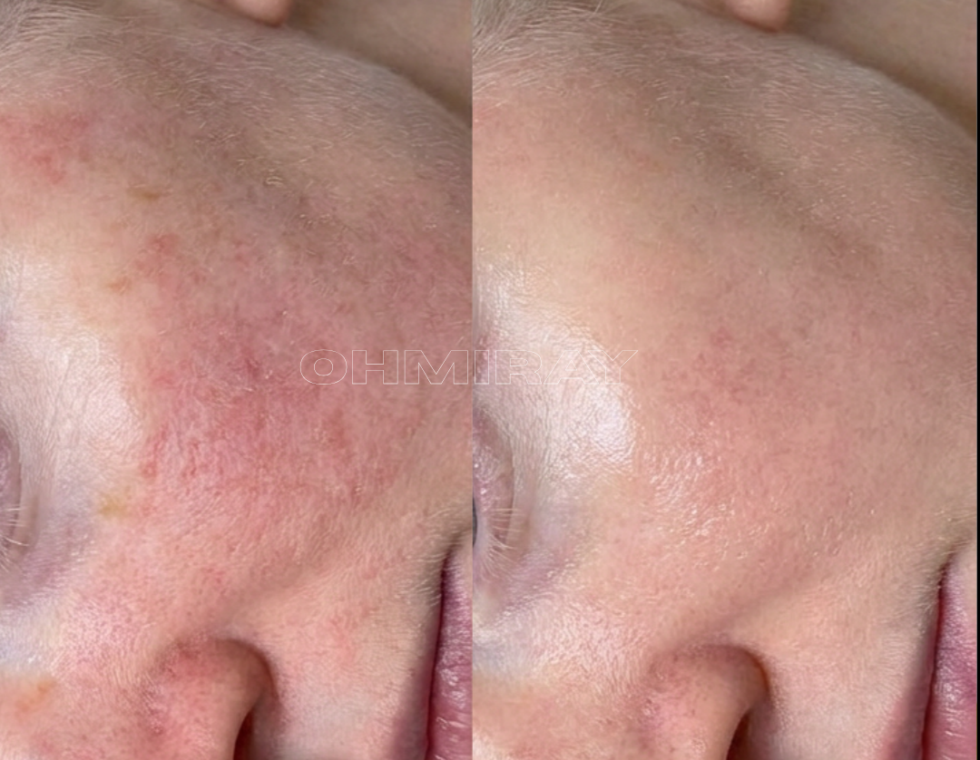 Side-by-side comparison of skin on a person's face, showing reduction in redness and blemishes on the right side.