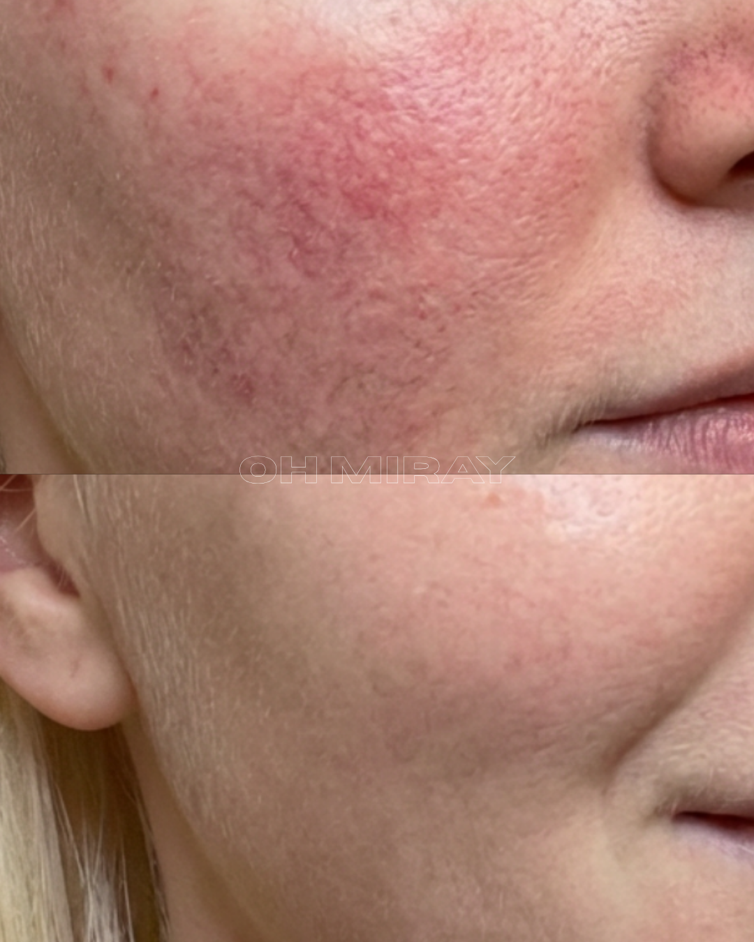 Close-up of a person's face showing clear skin and reduced redness after dermatological treatment.