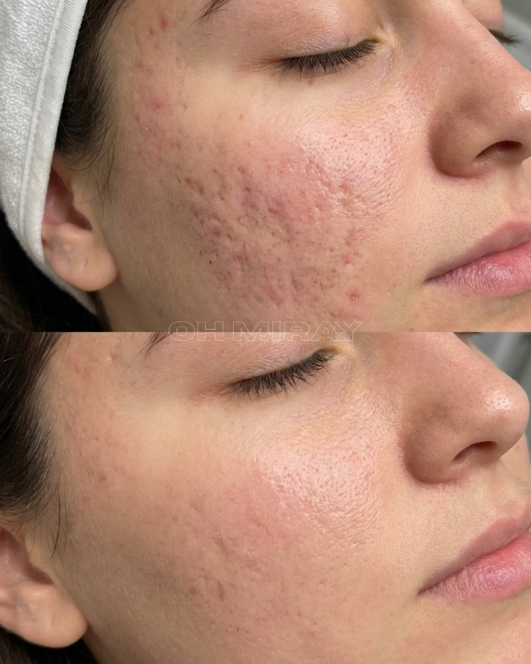 Close-up before and after images of a woman's cheek showing improvement in skin texture and acne scars.