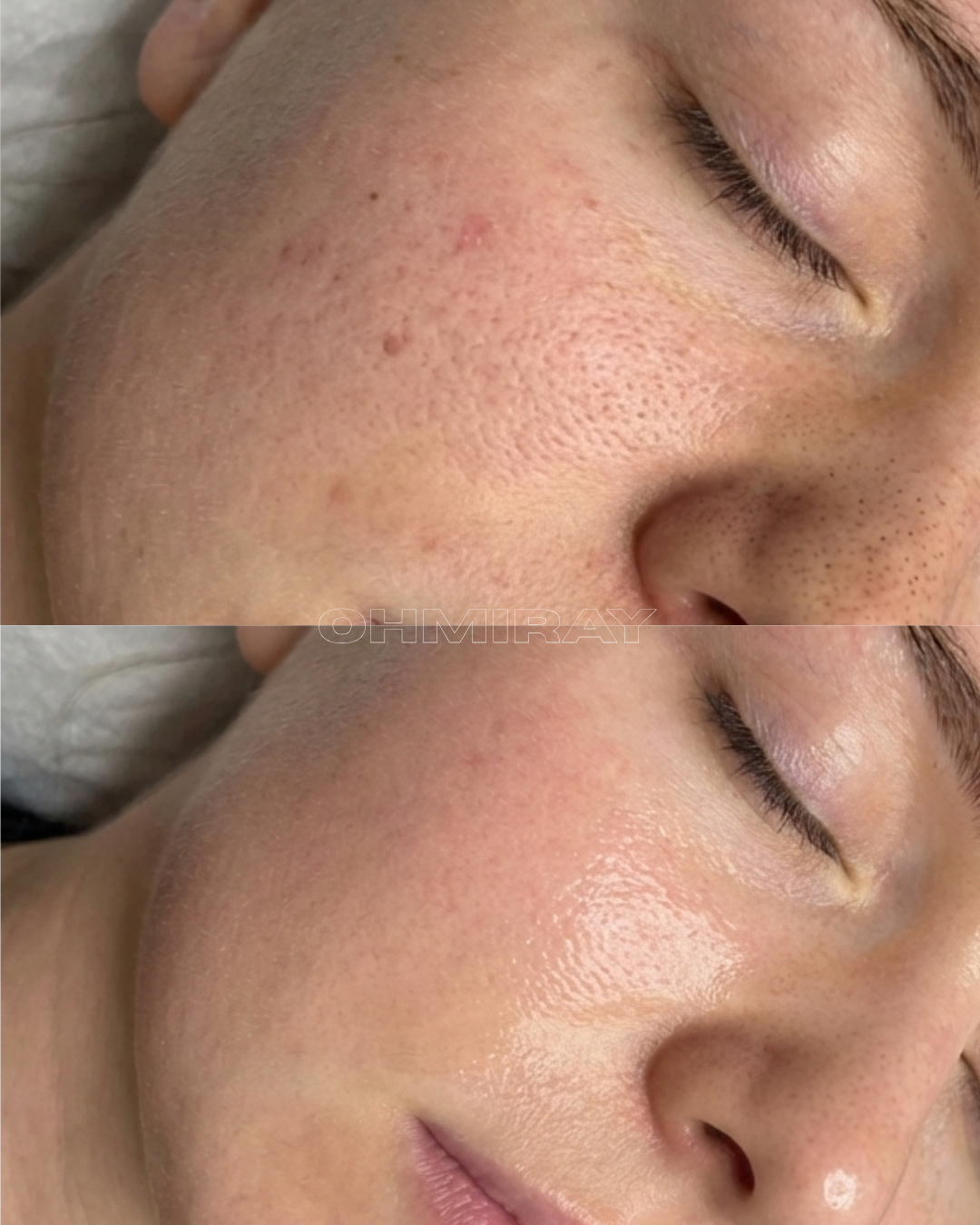 Close-up of a person's face showing a before-and-after comparison, with improved skin texture and reduced pore size in the after image.