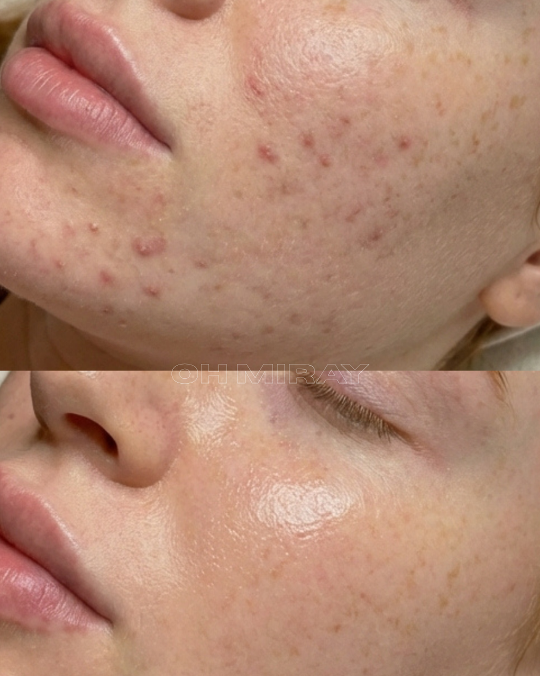 Before and after comparison of facial skin showing improvement in acne and skin texture.