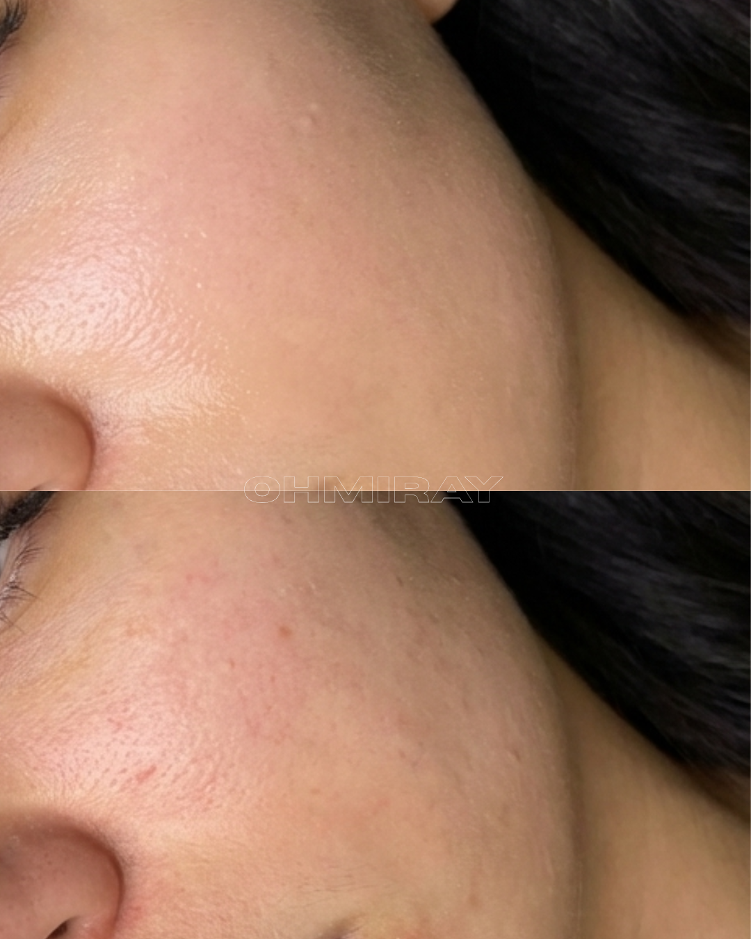 Close-up of a person's cheek and hairline showing skin before and after a skincare treatment, with smoother skin in the top image and some redness and irritation in the bottom image.