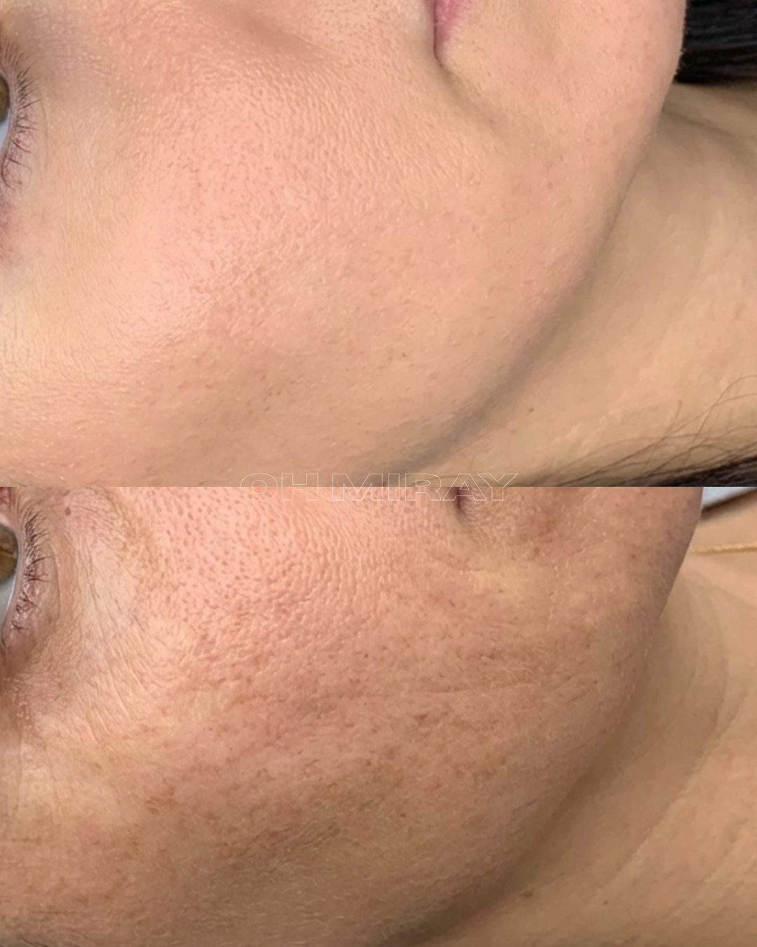 Close-up comparison of skin texture, showing improvements in skin smoothness and pore appearance.