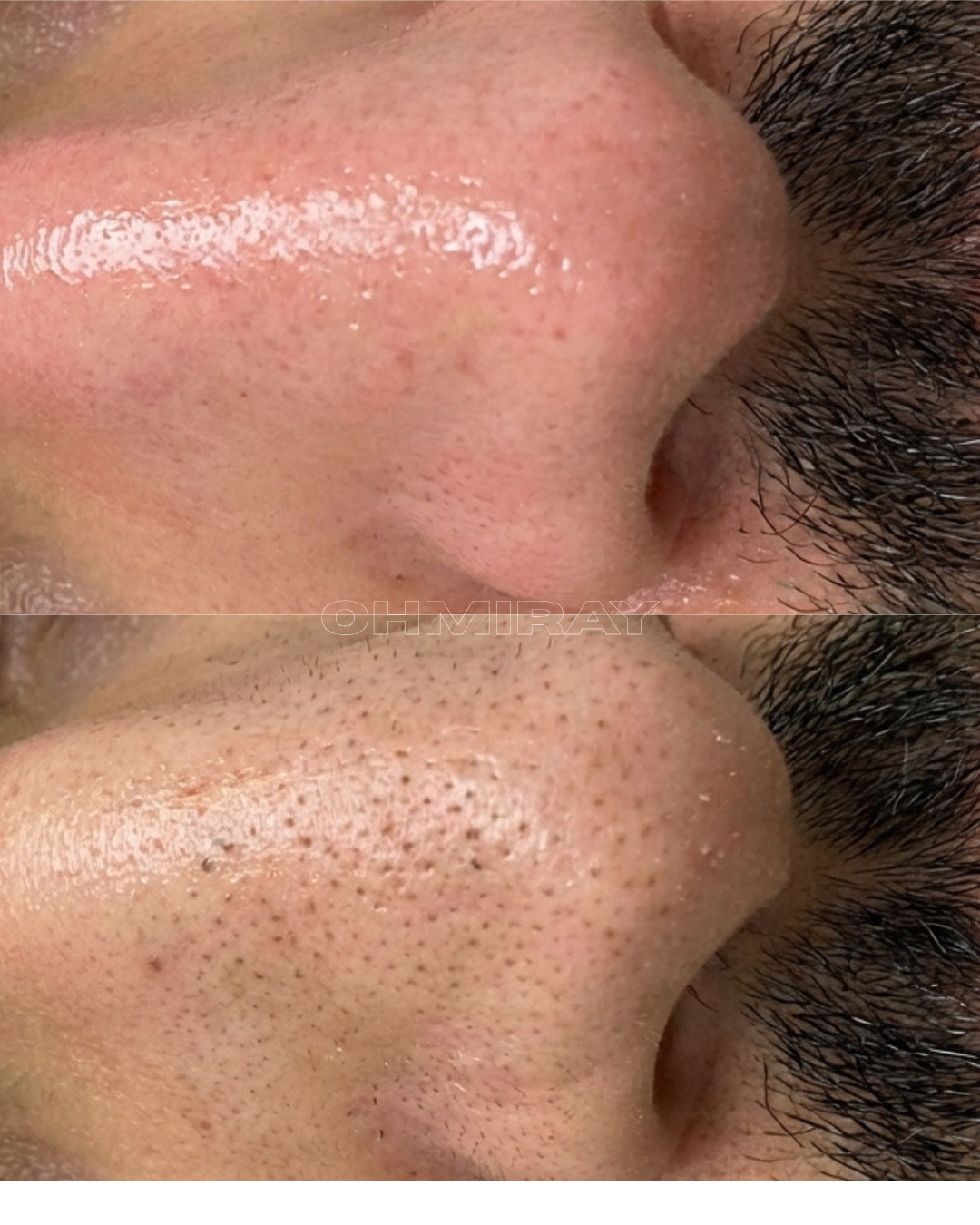 Close-up of a person's nose showing before and after skin treatment, with visible pore size reduction and improved skin texture.