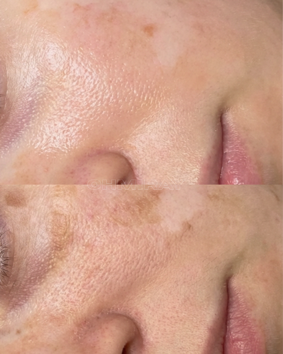 Close-up of a person's nose, cheek, and part of the lips showing skin texture and pores.