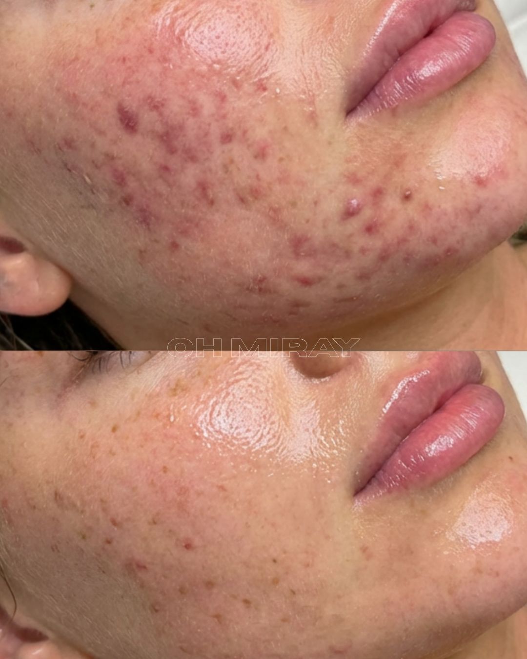 Comparison of a person's cheek showing severe acne with numerous red pimples and scars in the top image, and clearer skin with fewer blemishes in the bottom image, suggesting skin improvement or treatment.