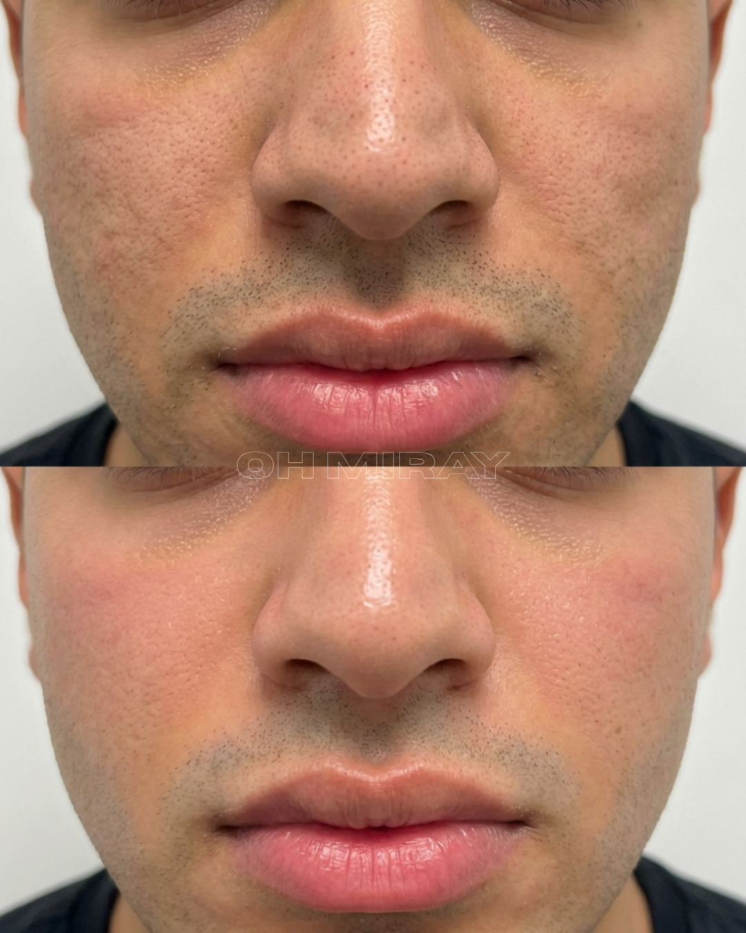 Close-up comparison of a man's nose and lips before and after a cosmetic dermatology treatment, showing smoother skin and improved texture in the after image.