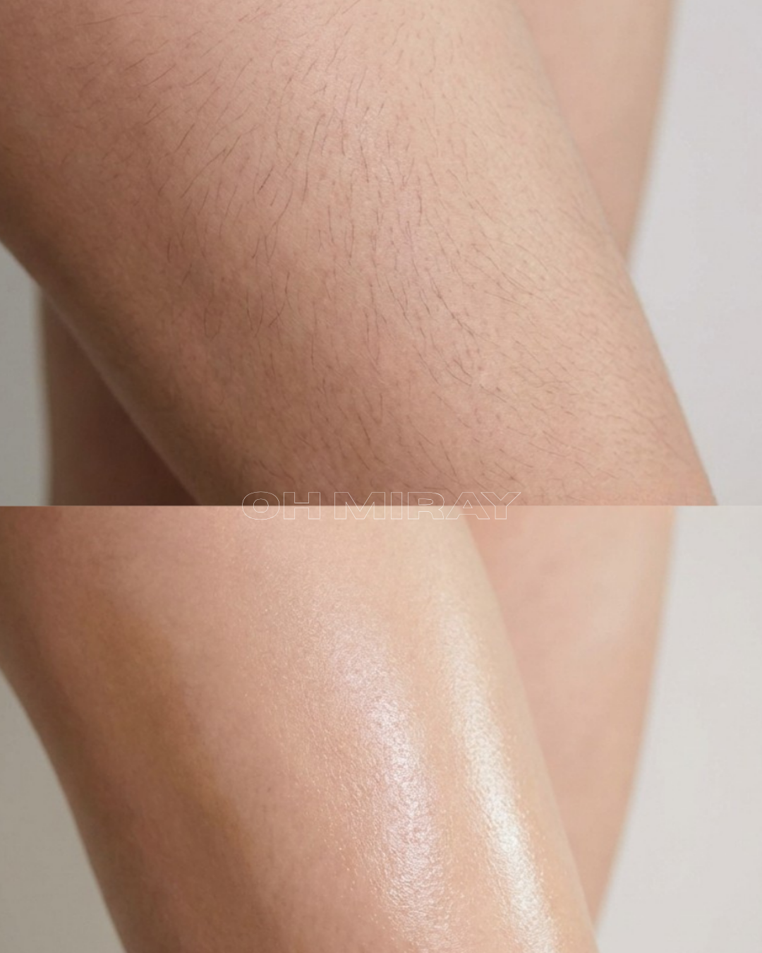 Comparison of a person's leg before and after hair removal, showing smoother, hairless skin in the after image.