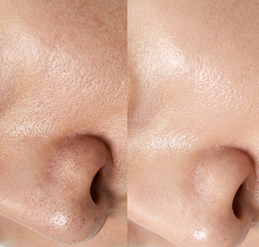 Close-up comparison of a person's nose before and after skin treatment showing reduction in blackheads and improved skin texture.