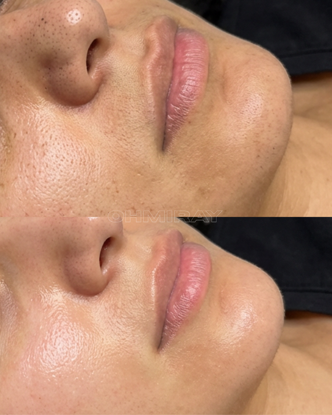 Close-up of a person's face before and after skin treatment, showing improved skin texture and reduced pore appearance.