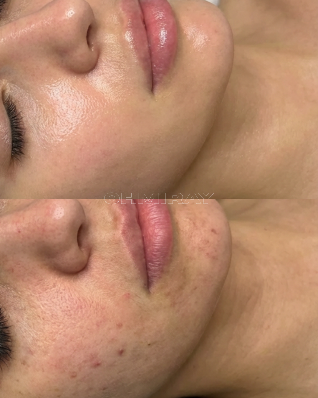 Close-up of a woman's face and shoulder showing before and after skin treatment, with reduced redness and acne scars in the after image.