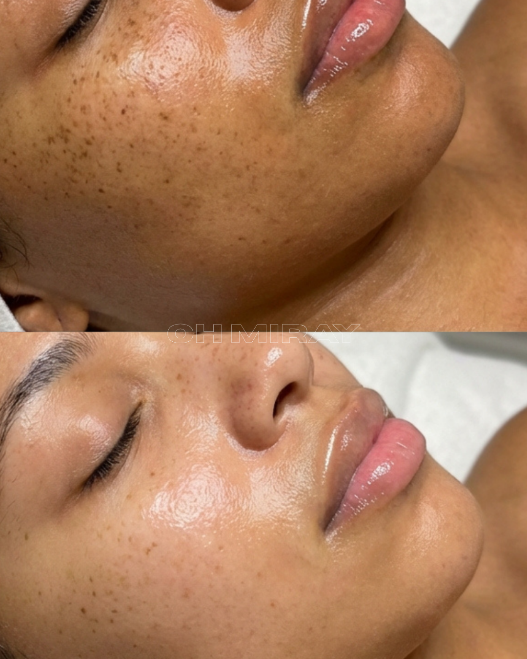 Close-up of a woman's face before and after a skincare treatment showing reduced freckles and clearer, smoother skin.