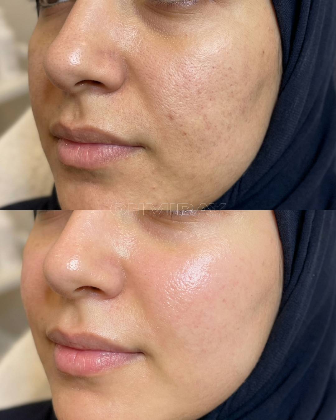Close-up of a woman's face showing skin before and after a skincare treatment, with visible improvements in skin texture and clarity.