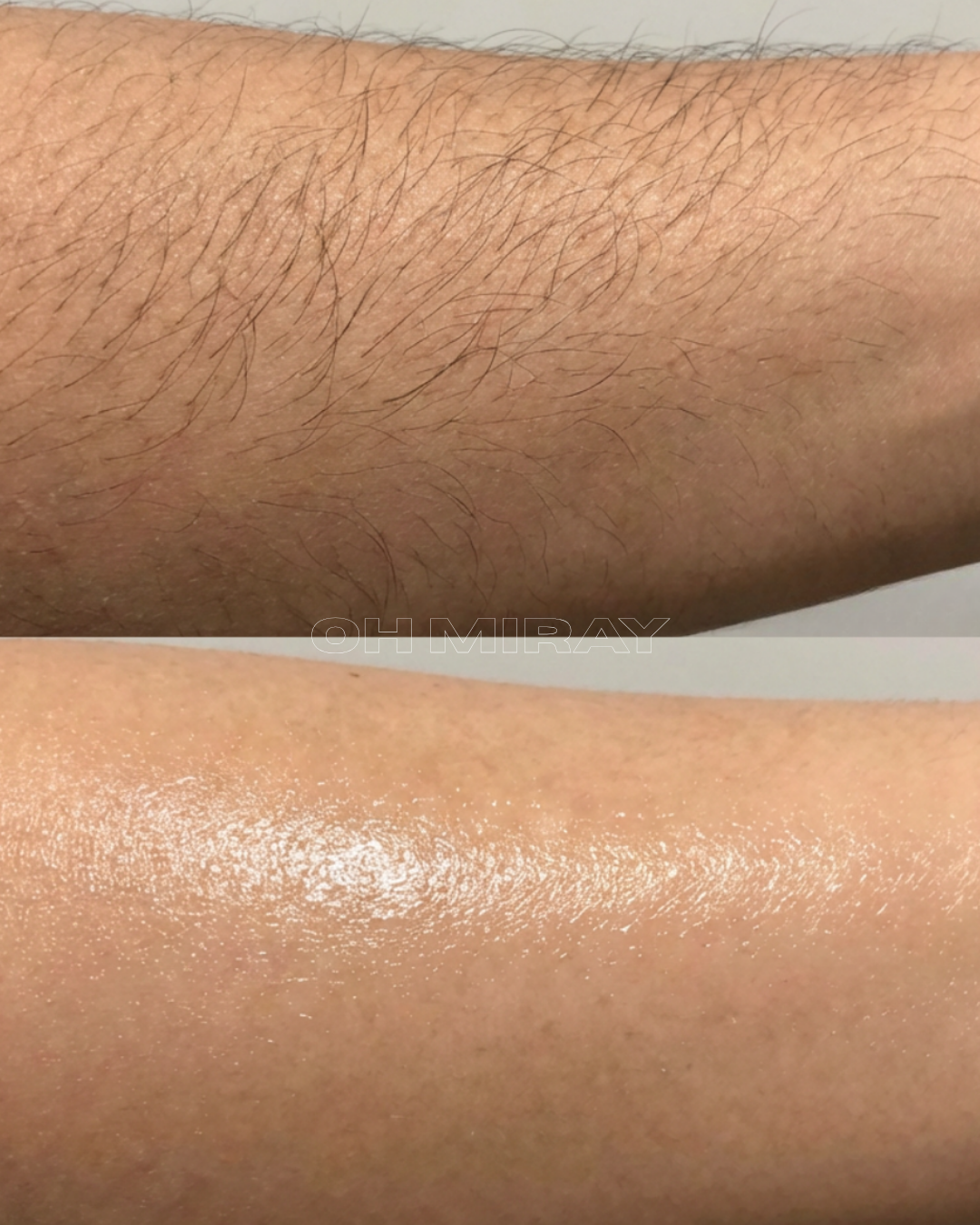 Close-up of two forearms, one with visible hair and the other smooth and shiny.