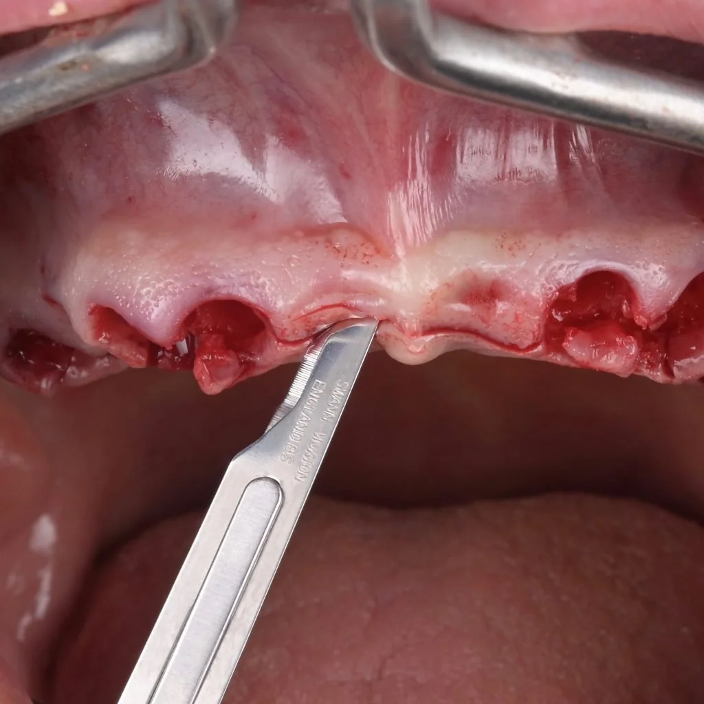 Immagine di una bocca con ferite sul palato superiore, che mostra sangue e tessuti infiammati, mentre un bisturi viene utilizzato per un intervento odontoiatrico.
