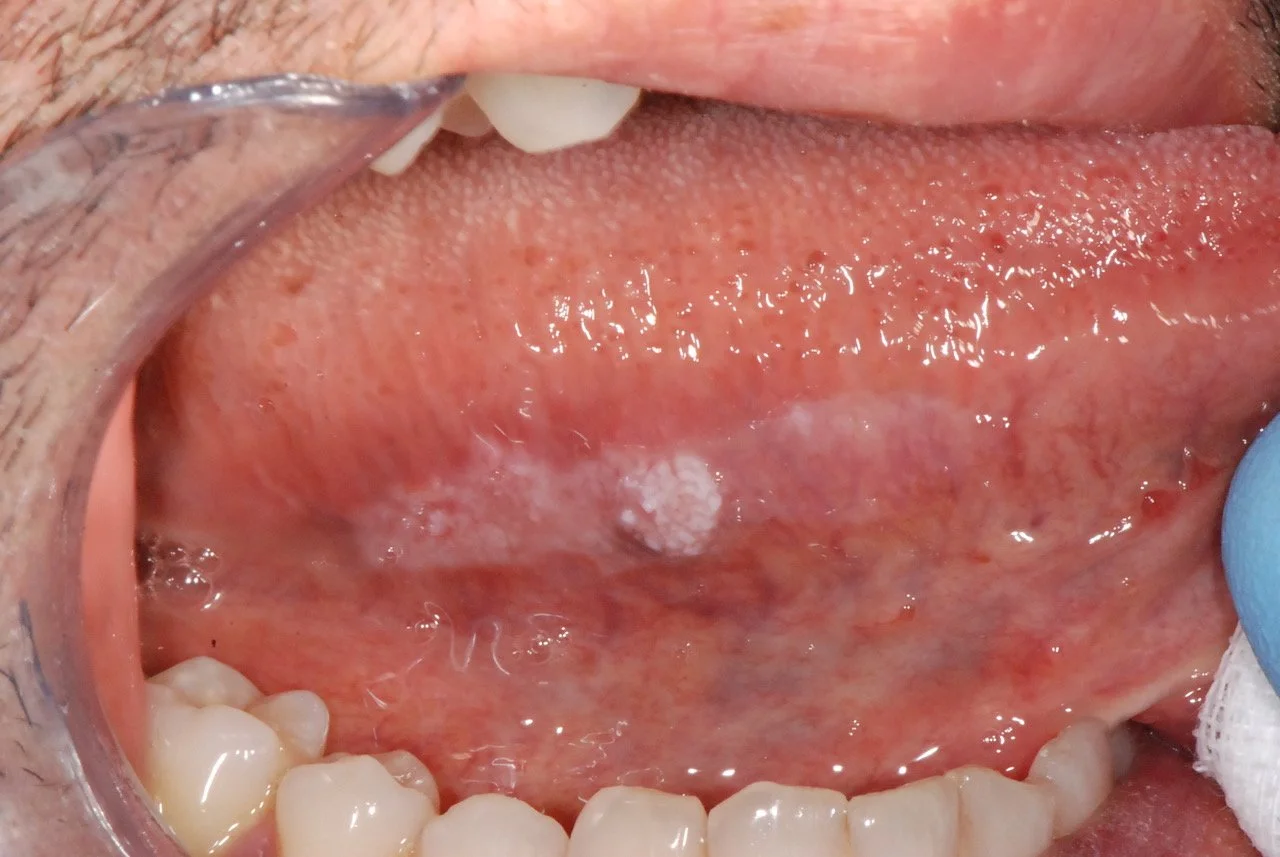 Cattura di un'apertura orale con presenza di una lesione bianca sulla mucosa della bocca.