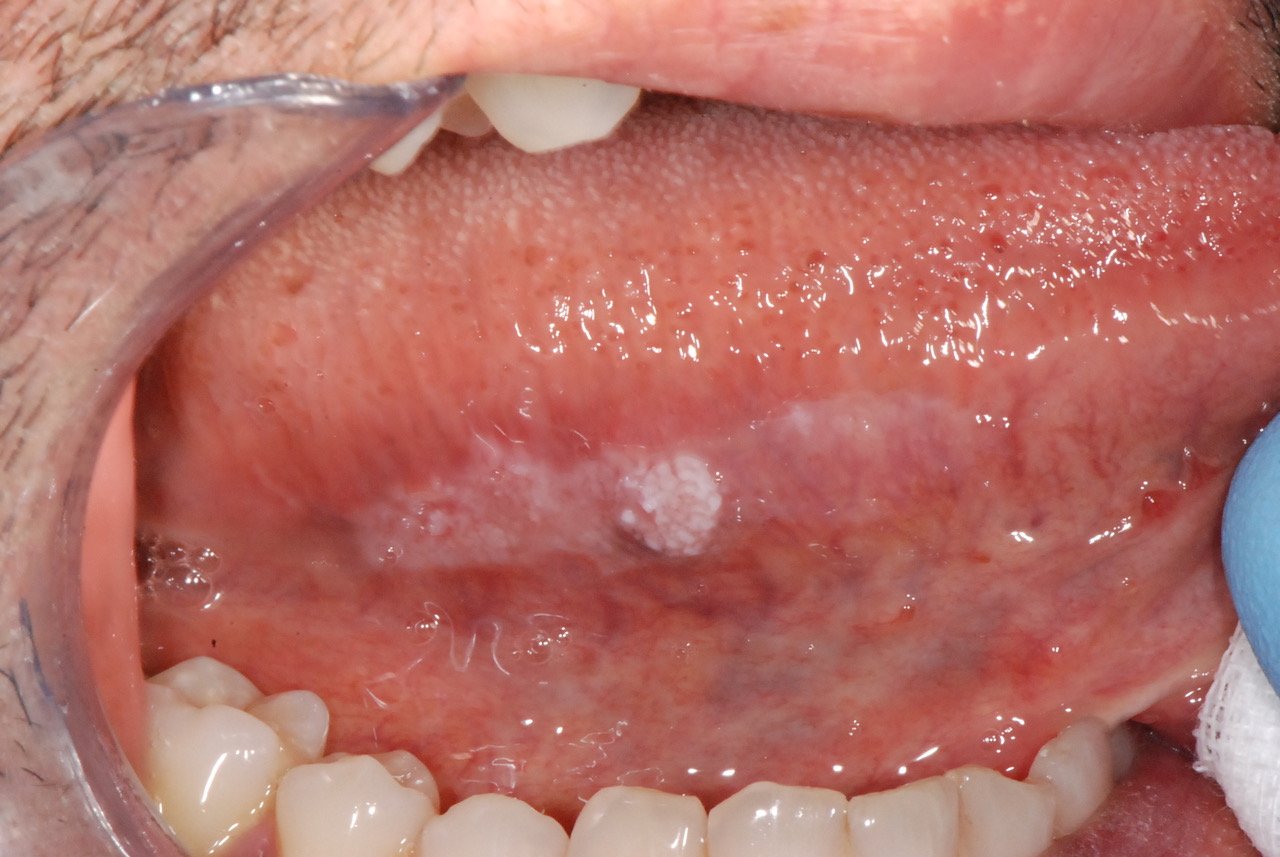Interno della bocca con una lesione bianca sulla mucosa della lingua, possibile candidosi orale.