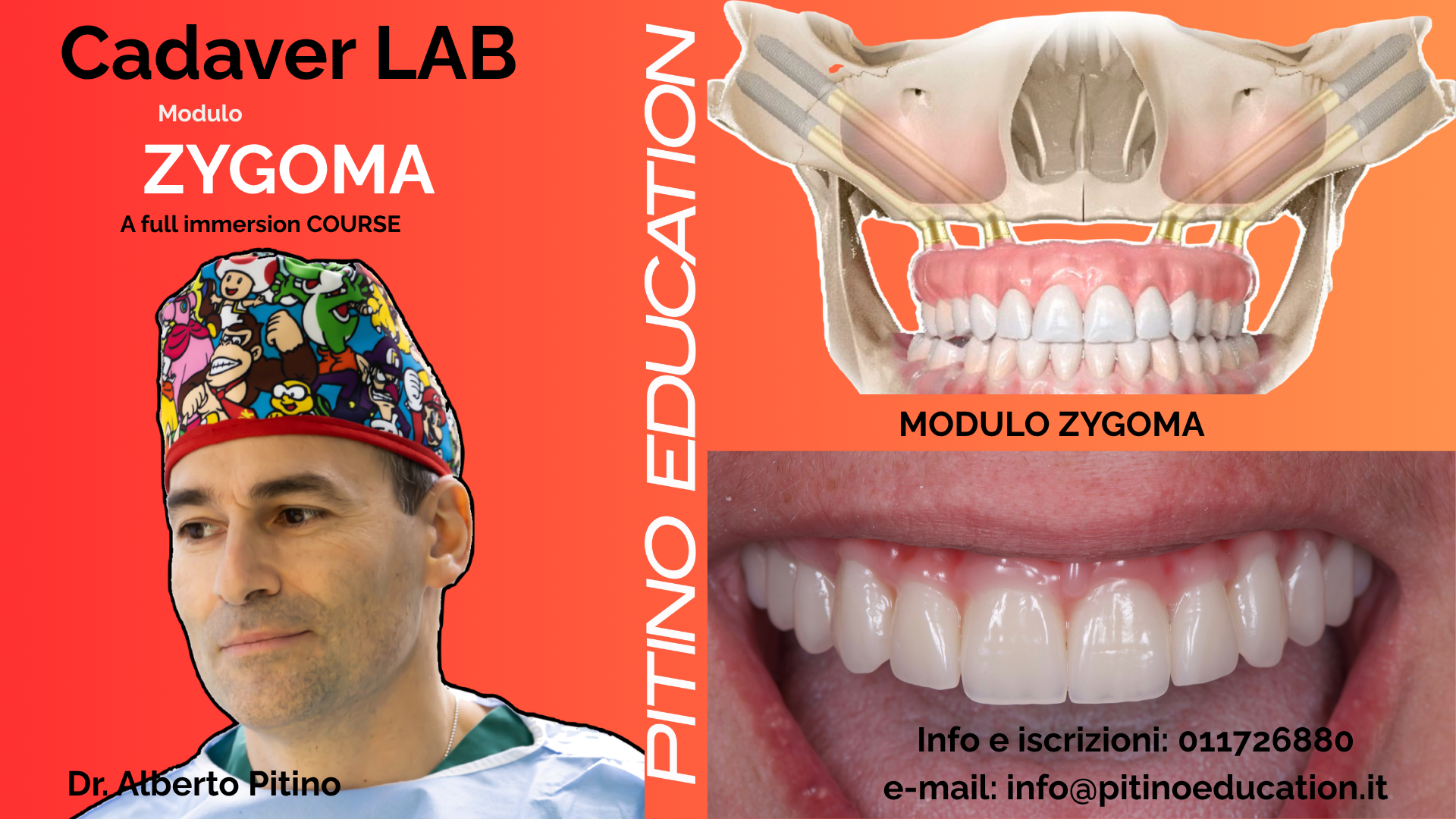 Cadaver Lab Zygomatic Implants – Full Immersion Experience
