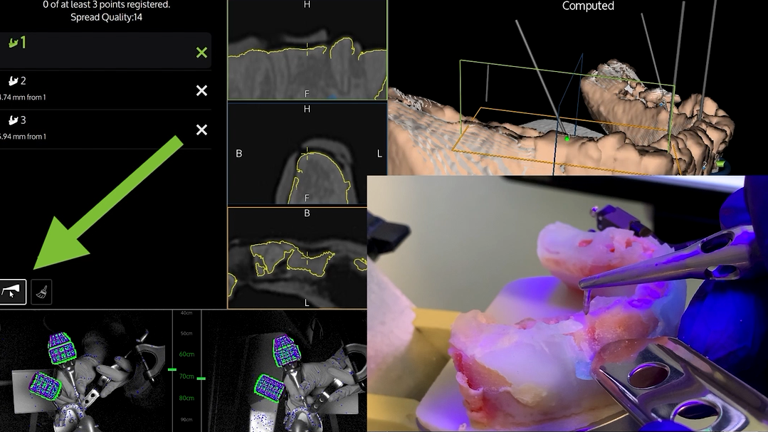 Immagine che mostra una massiccia pianificazione digitale e strumenti chirurgici utilizzati in un intervento odontoiatrico o di implantologia, con modelli di osso e denti in una schermata di computer. In basso a destra, una presa di immagini di un intervento reale in corso.