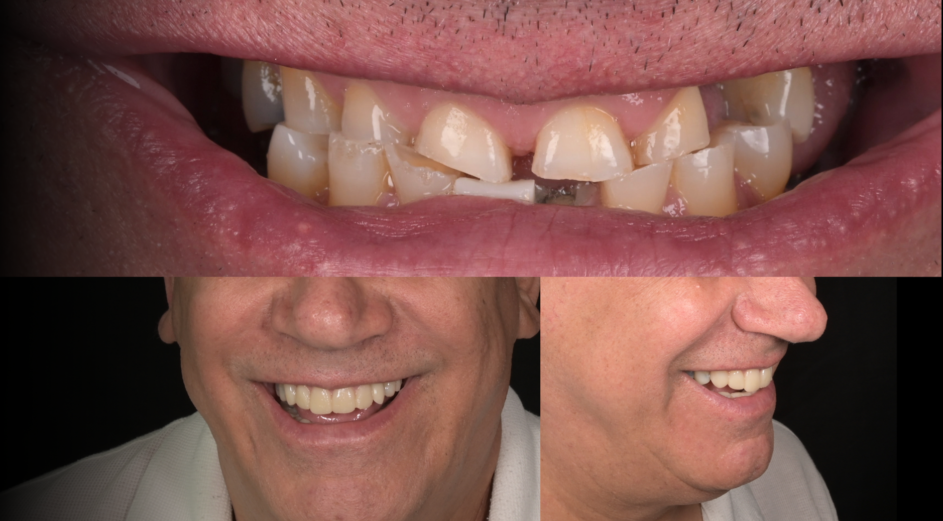 Immagini che mostrano un prima e dopo di un trattamento dentale. La prima immagine mostra denti irregolari e scheggiati, mentre le altre immagini mostrano un sorriso con denti più allineati e estetici.