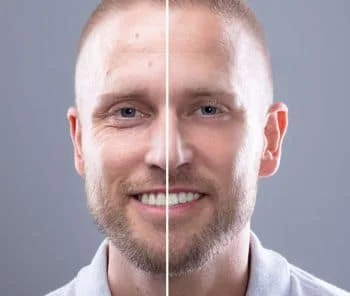 RF Microneedling