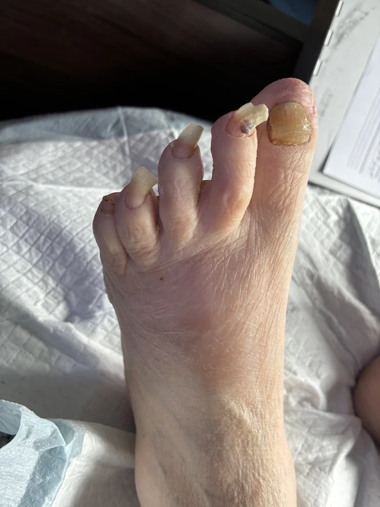 Before foot care treatment result