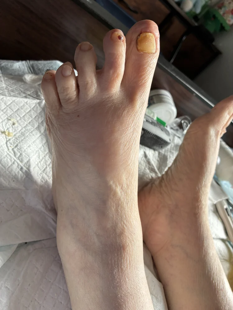 After foot care treatment result