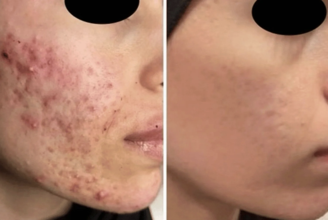 Side-by-side comparison of a person's face showing before and after treatments for severe acne, with the left side displaying active acne and the right side showing clear skin.