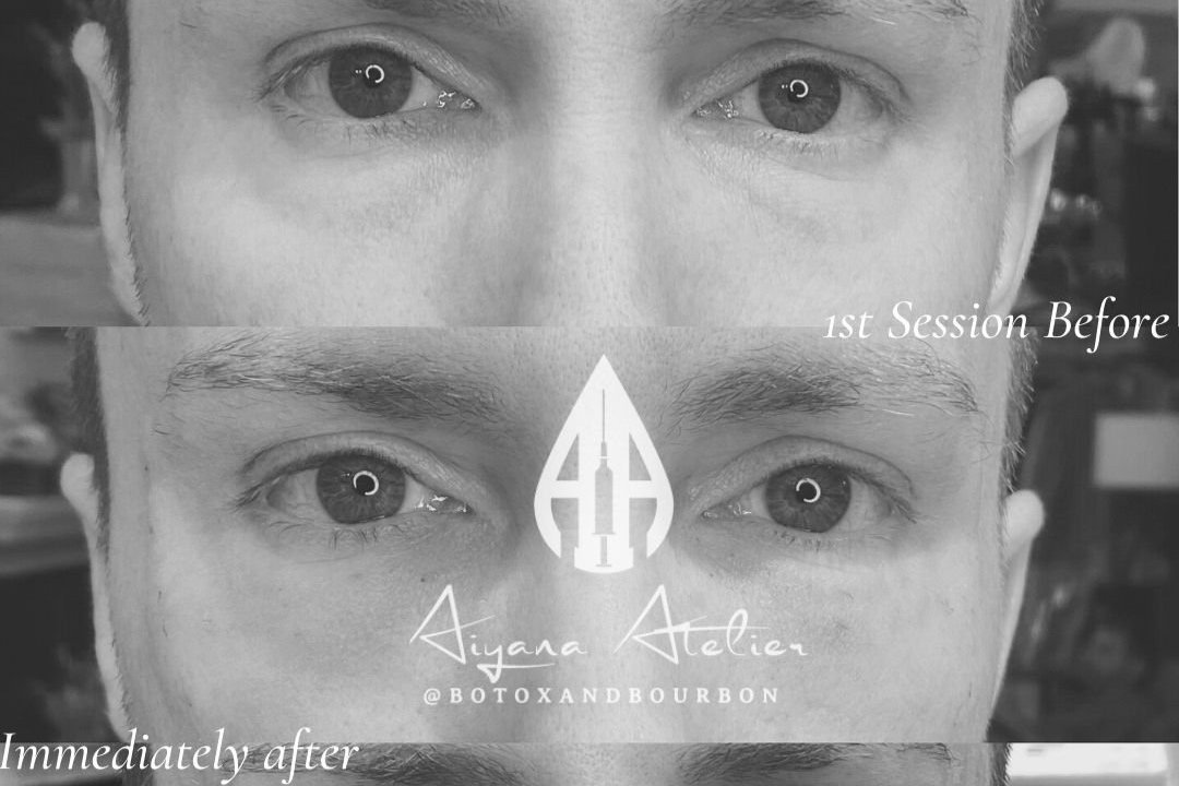 Getting Over the Under Eye Area